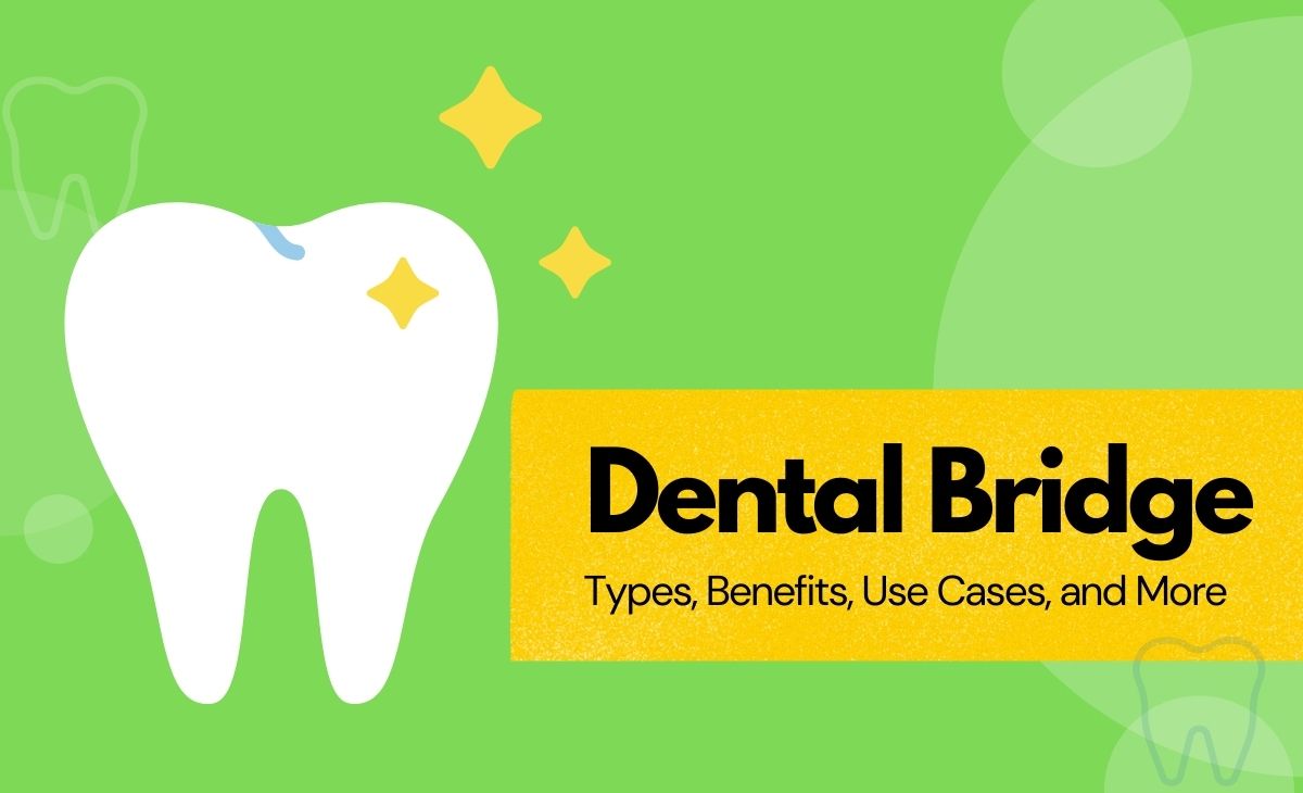 Dental Bridge: Types, Benefits, Use Case and Costs