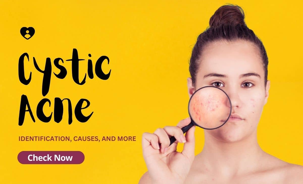 Cystic Acne: Identification, Causes, and More - Resurchify