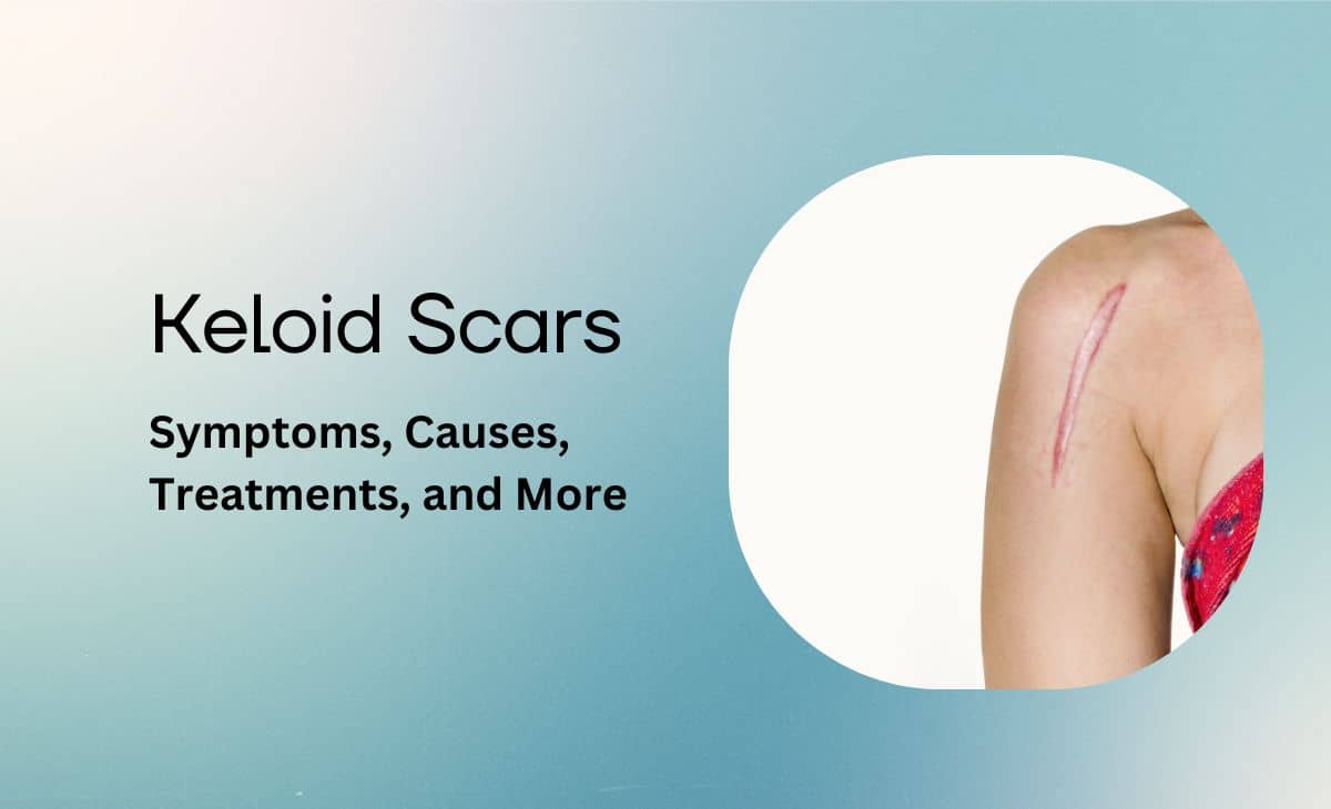 Keloid Scars Symptoms, Causes, and Treatments Resurchify