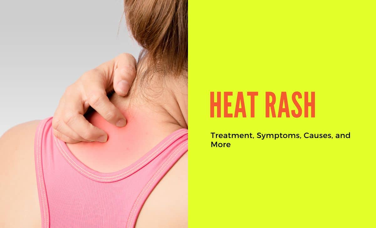 Heat rash remedies online