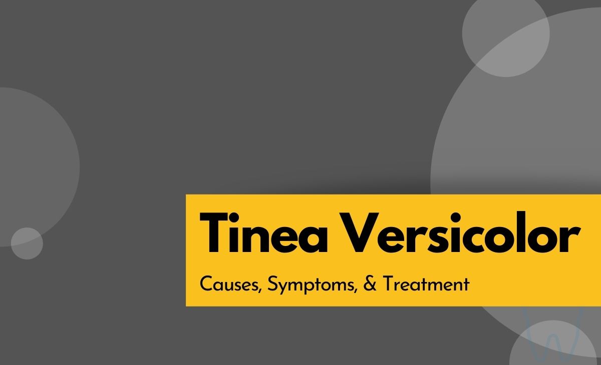 Tinea Versicolor Causes, Symptoms, and Treatment Resurchify