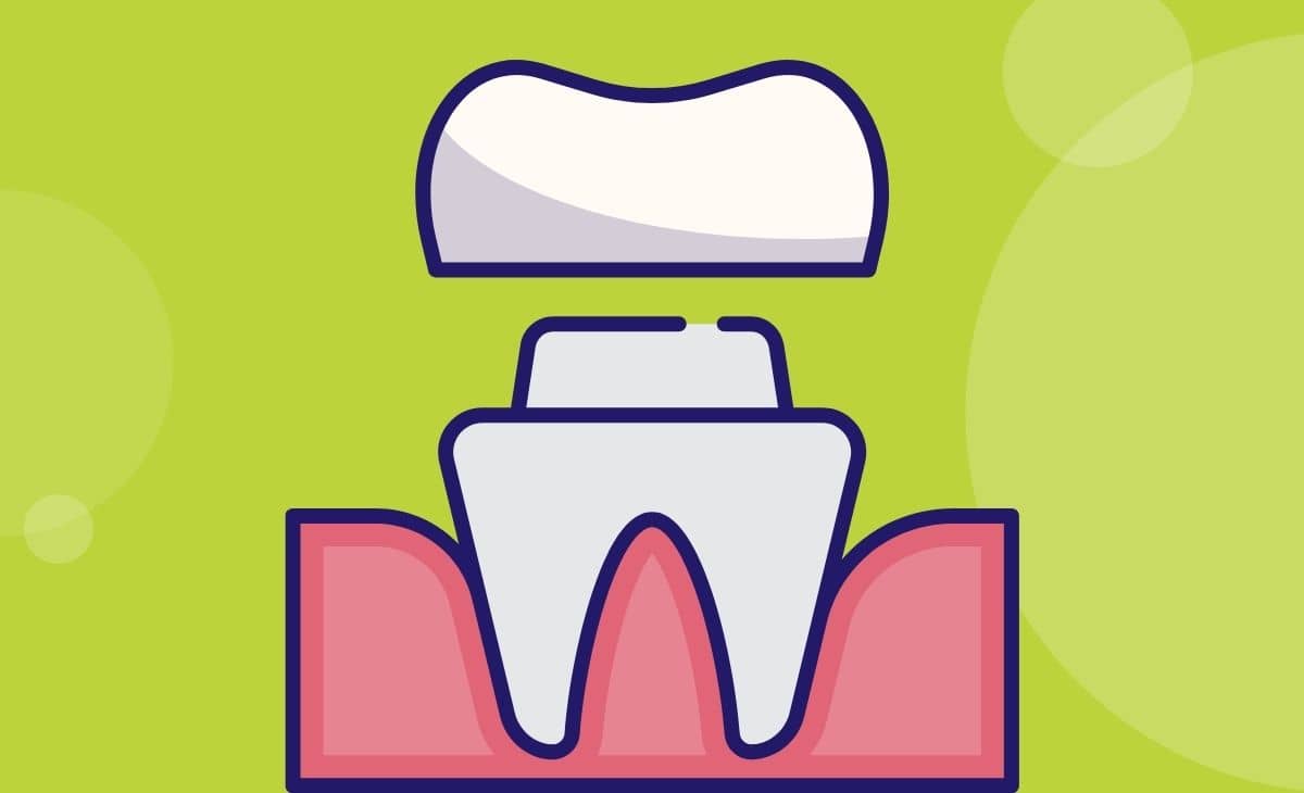 Dental Crown Types, Procedure, When It's Done, Cost, and More Resurchify