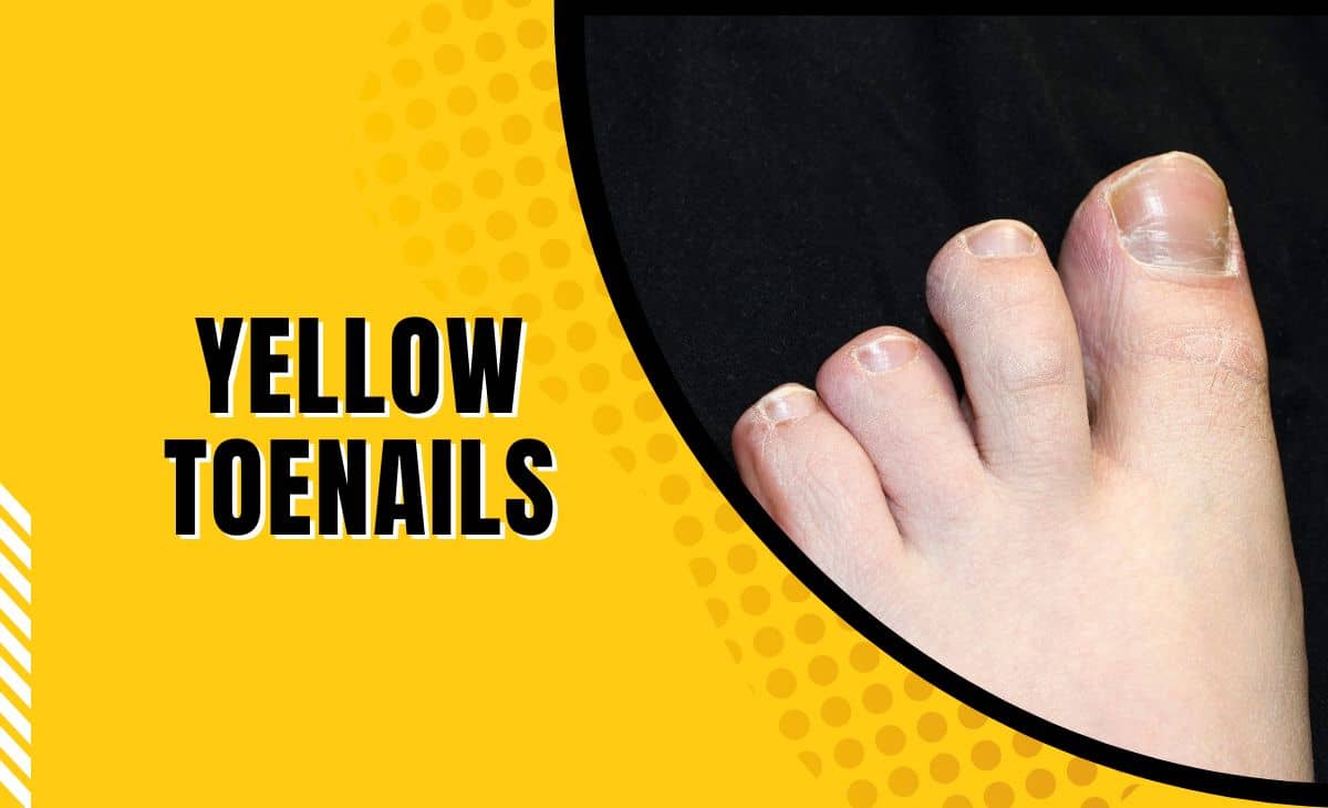 Yellow Toenails: Causes, Prevention, and Treatments - Resurchify