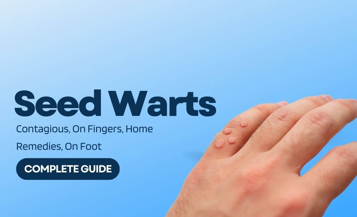 Seed Warts Contagious, On Fingers, Home Remedies, On Foot Resurchify
